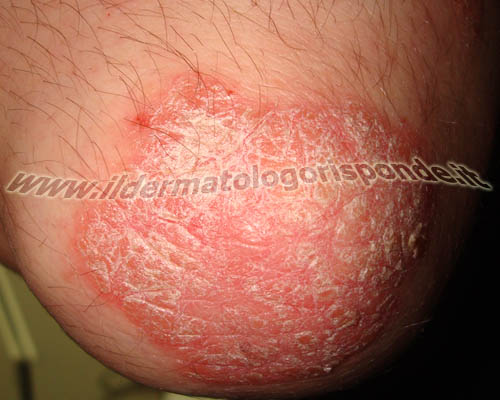 Psoriasi di tumore della pelle