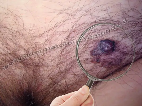 vulvodinia foto vestibolite vulvare in paziente con vulvodinia e melanoma vulvare