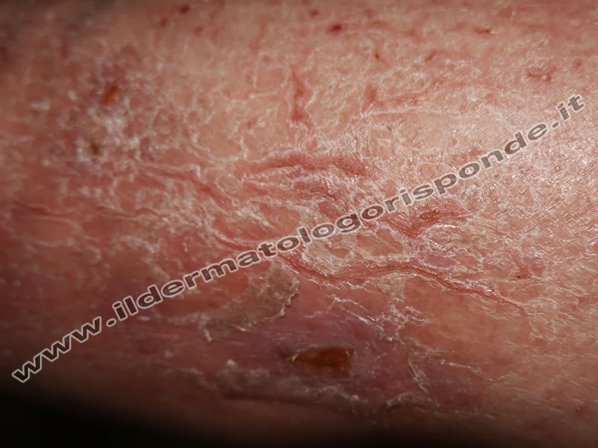 eczema craquelé Paziente con eczema craquelé, eczema fendillé o eczema cannellé